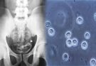 Adult Cystitis and Hematuria