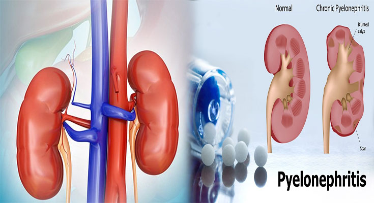 How to Tell if You Have Pyelonephritis or Cystitis