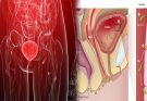 Interstitial Cystitis & Recurrent Bladder Infections