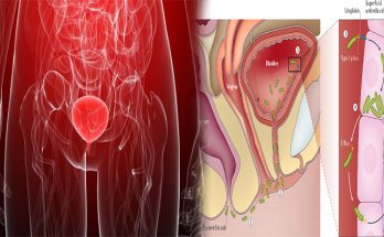 Interstitial Cystitis & Recurrent Bladder Infections