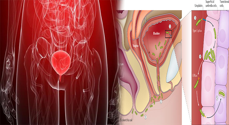 Interstitial Cystitis & Recurrent Bladder Infections