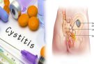 Treatment For Interstitial Cystitis