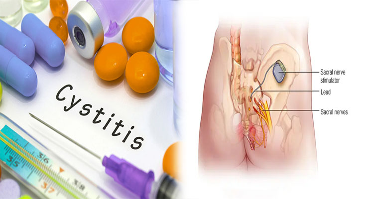 Treatment For Interstitial Cystitis